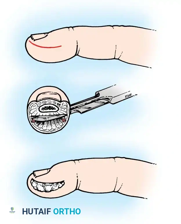 Incision posterior to digital artery and nerve