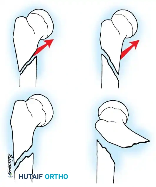 Comprehensive Management of Pediatric Femoral Fractures