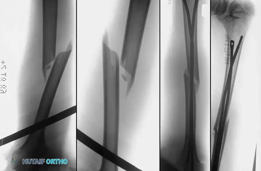 Spica Cast Application