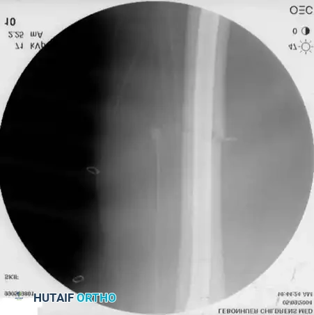 ESIN Lateral Radiograph