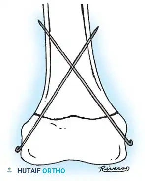 Rigid Nailing Proximal Locking