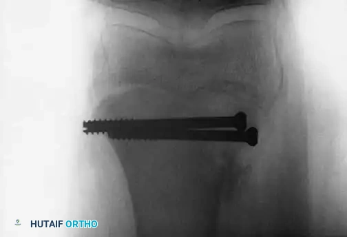 Supracondylar Fracture Fixation
