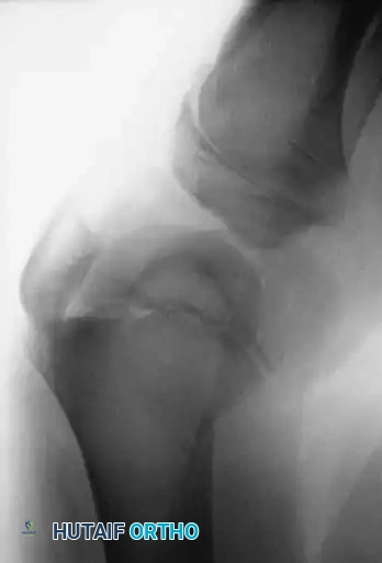 Physeal Fracture Fixation