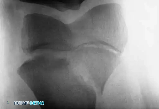 Distal Femoral Physeal Fracture