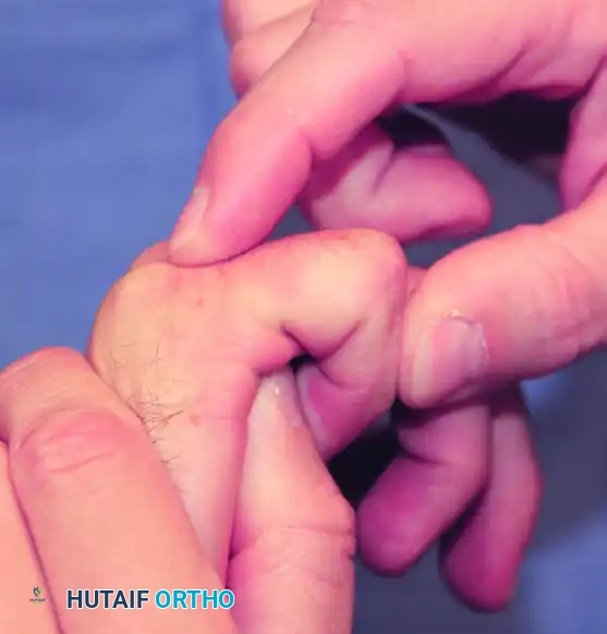 FIGURE 73-10 Test for tightness of oblique retinacular ligament. Proximal interphalangeal joint held in maximal extension by examiner. Resistance to passive flexion of distal interphalangeal joint is evaluated.