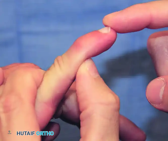 FIGURE 73-11 Swan-neck deformity. A, Terminal tendon rupture may be associated with synovitis of distal interphalangeal joint, leading to distal interphalangeal joint flexion and subsequent proximal interphalangeal joint hyperextension. Rupture of flexor digitorum superficialis tendon can be caused by infiltrative synovitis, which can lead to decreased volar support of proximal interphalangeal joint and subsequent hyperextension deformity. B, Lateral-band subluxation dorsal to axis of rotation of proximal interphalangeal joint. Contraction of triangular ligament and attenuation of transverse retinacular ligament are depicted.