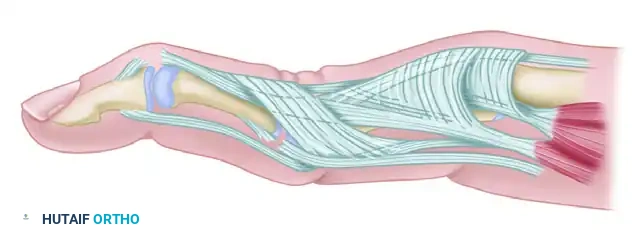 FINGER DEFORMITIES CAUSED BY RHEUMATOID ARTHRITIS Surgical Diagram