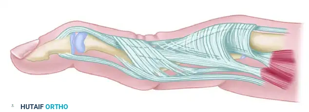 FINGER DEFORMITIES CAUSED BY RHEUMATOID ARTHRITIS Surgical Diagram