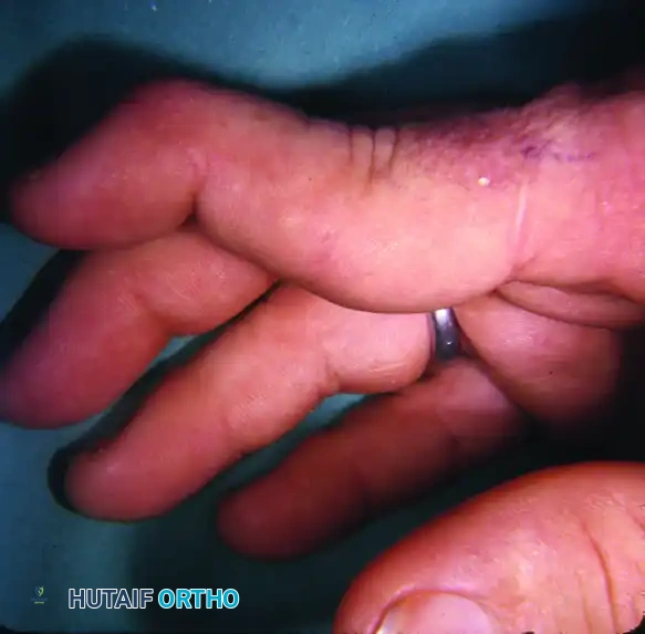 FIGURE 73-12 Fixed rheumatoid swan-neck deformity, with proximal interphalangeal joint hyperextension and distal interphalangeal joint flexion.