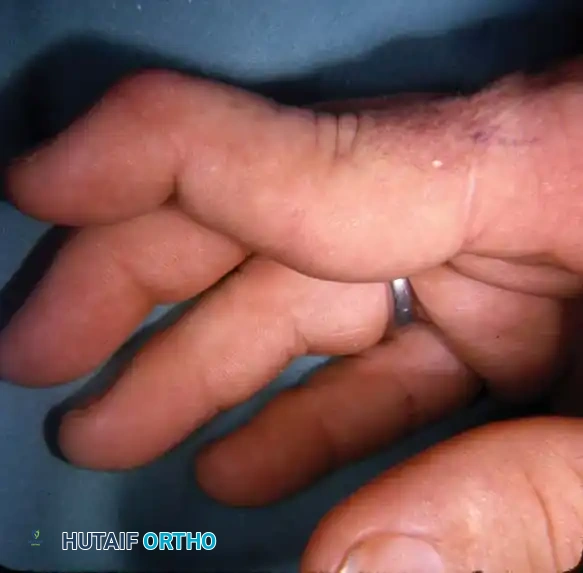 Fixed rheumatoid swan-neck deformity