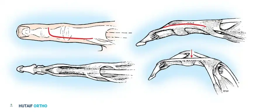 Radiographic progression of rheumatoid changes