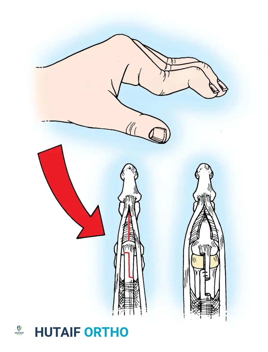 Intraoperative view of the extensor mechanism