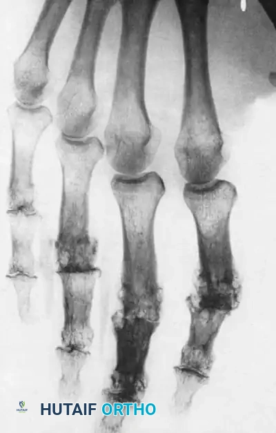 Synovectomy and tendon exposure
