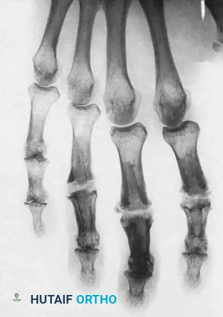 Exposure of the A2 pulley