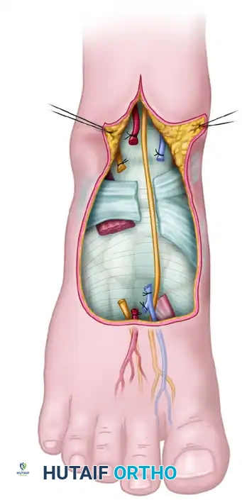 FIGURE 63-55 Variations in circulation to first web space.
