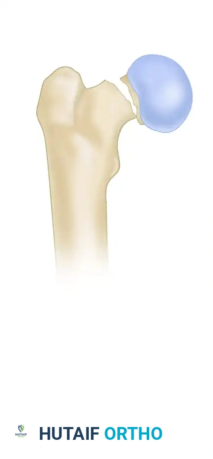 FIXATION OF FEMORAL NECK FRACTURE WITH CANNULATED SCREWS Surgical Diagram