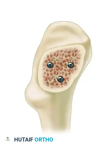 FIXATION OF FEMORAL NECK FRACTURE WITH CANNULATED SCREWS Surgical Diagram