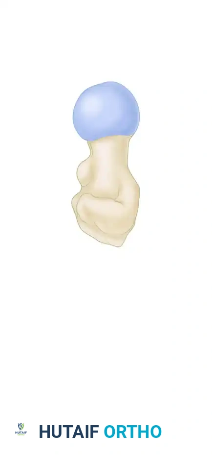 FIXATION OF FEMORAL NECK FRACTURE WITH CANNULATED SCREWS Surgical Diagram