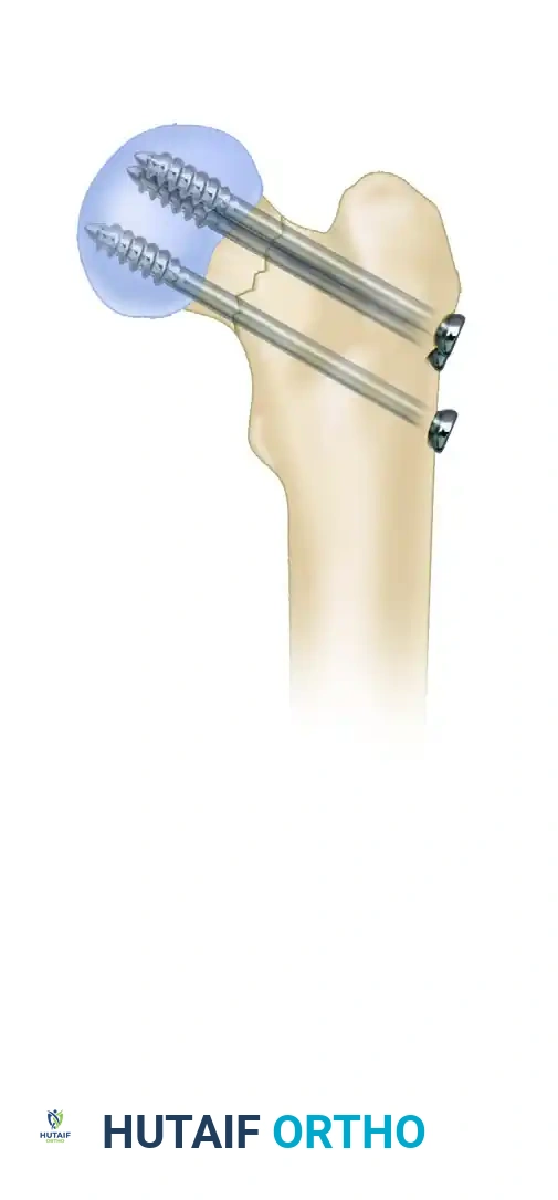 FIXATION OF FEMORAL NECK FRACTURE WITH CANNULATED SCREWS Surgical Diagram