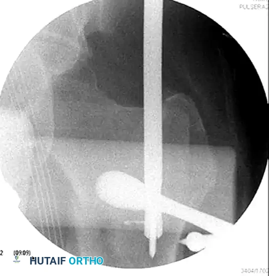 FIXATION OF SUBTROCHANTERIC FEMORAL FRACTURE WITH A PROXIMAL FEMORAL LOCKING PLATE Surgical Diagram