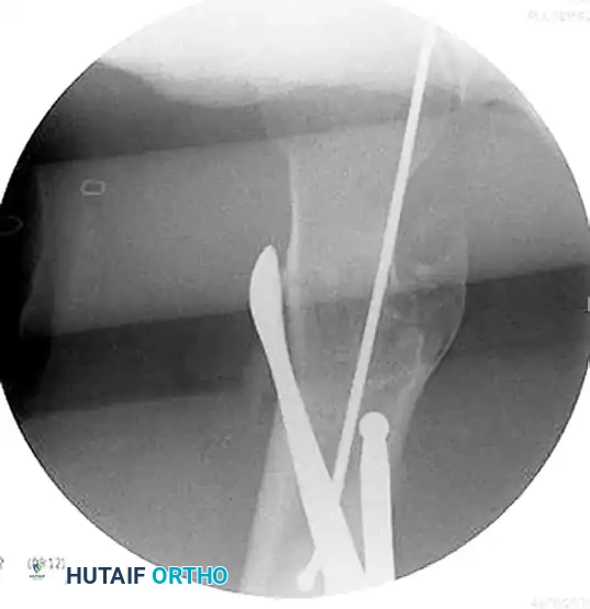 FIXATION OF SUBTROCHANTERIC FEMORAL FRACTURE WITH A PROXIMAL FEMORAL LOCKING PLATE Surgical Diagram