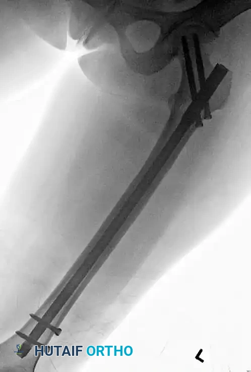 FIXATION OF SUBTROCHANTERIC FEMORAL FRACTURE WITH A PROXIMAL FEMORAL LOCKING PLATE Surgical Diagram