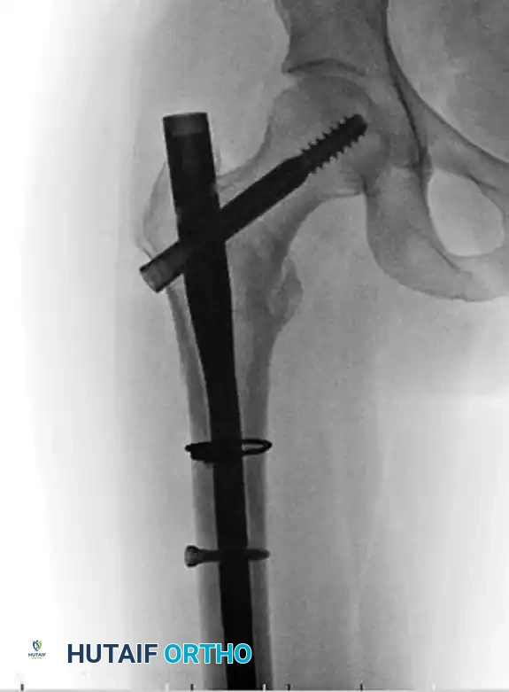 FIXATION OF SUBTROCHANTERIC FEMORAL FRACTURE WITH A PROXIMAL FEMORAL LOCKING PLATE Surgical Diagram