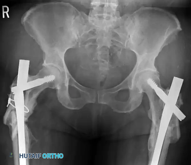 FIGURE 55-46 To correct suboptimal portal, a small plate can be placed in reamed lateral track and more medial portal established. (Redrawn from Gardner MJ, Henley HB: Harborview illus trated tips and tricks in fracture surgery , Philadelphia, 2010, Lippincott Williams and Wilkins.)