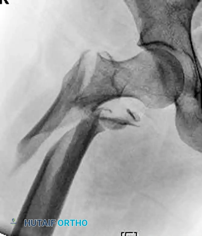 FIXATION OF SUBTROCHANTERIC FEMORAL FRACTURE WITH A PROXIMAL FEMORAL LOCKING PLATE Surgical Diagram