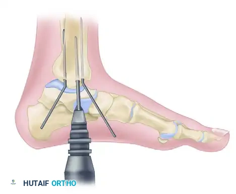 FIXATION OF THE LATERAL MALLEOLUS Surgical Diagram