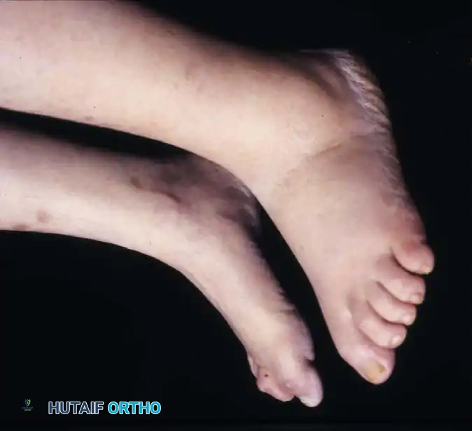 FIXED DEFORMITIES IN THE DIABETIC FOOT Surgical Diagram