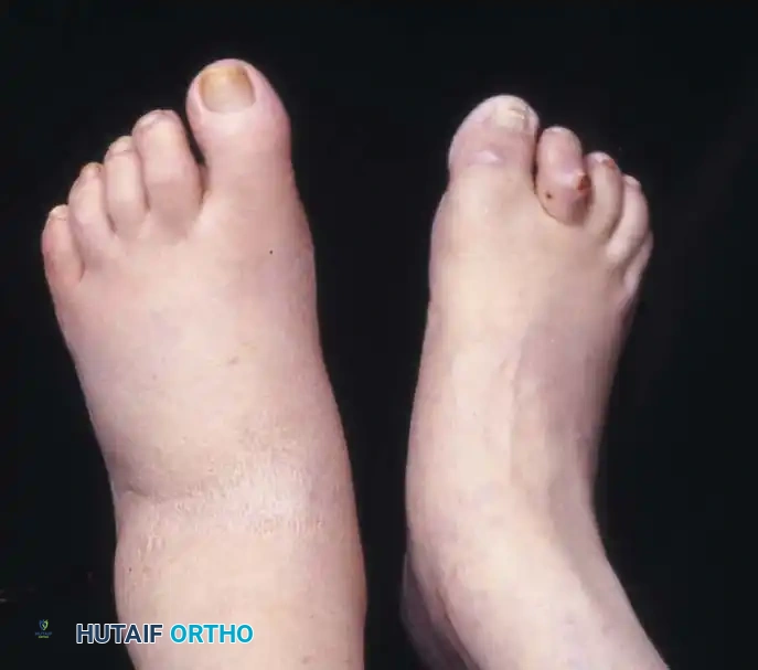 Surgical Management of Fixed Deformities and Charcot Arthropathy