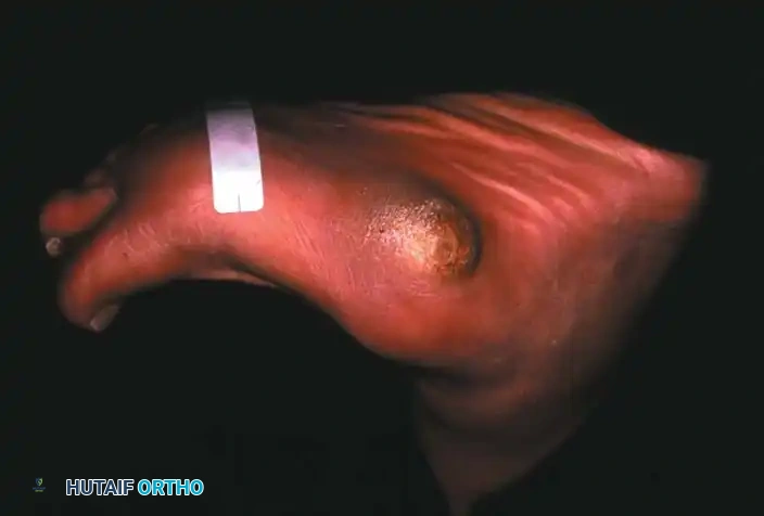 FIXED DEFORMITIES IN THE DIABETIC FOOT Surgical Diagram