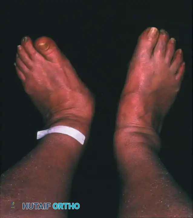 FIXED DEFORMITIES IN THE DIABETIC FOOT Surgical Diagram