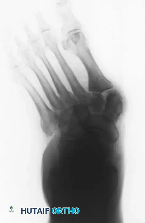 FIXED DEFORMITIES IN THE DIABETIC FOOT Surgical Diagram