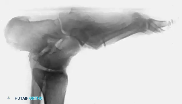 FIXED DEFORMITIES IN THE DIABETIC FOOT Surgical Diagram