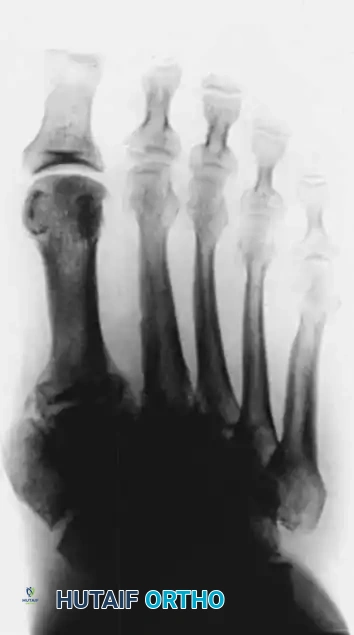 FIXED DEFORMITIES IN THE DIABETIC FOOT Surgical Diagram
