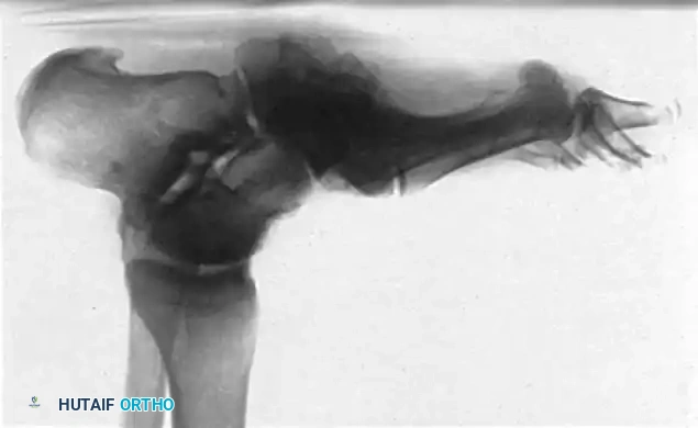 FIXED DEFORMITIES IN THE DIABETIC FOOT Surgical Diagram