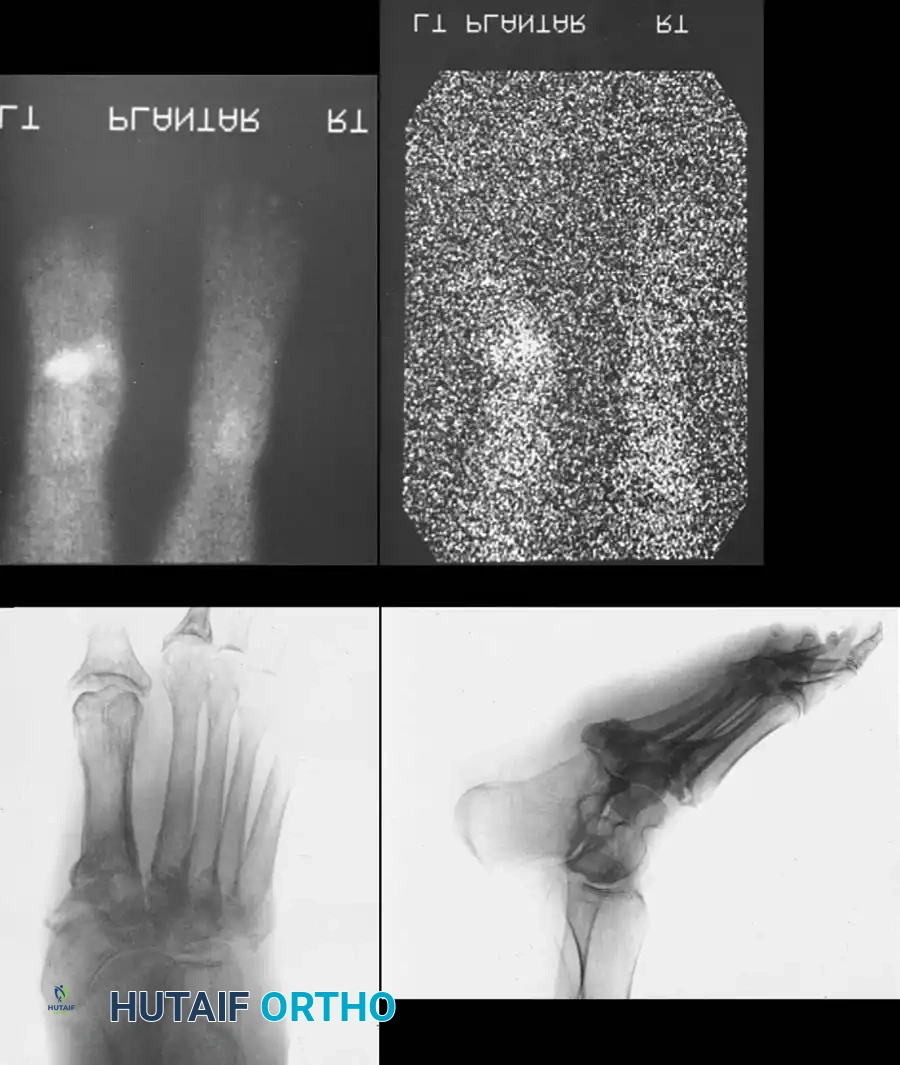 FIXED DEFORMITIES IN THE DIABETIC FOOT Surgical Diagram