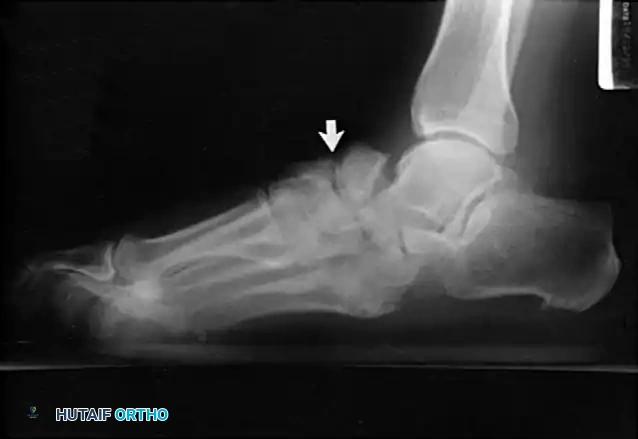FIXED DEFORMITIES IN THE DIABETIC FOOT Surgical Diagram