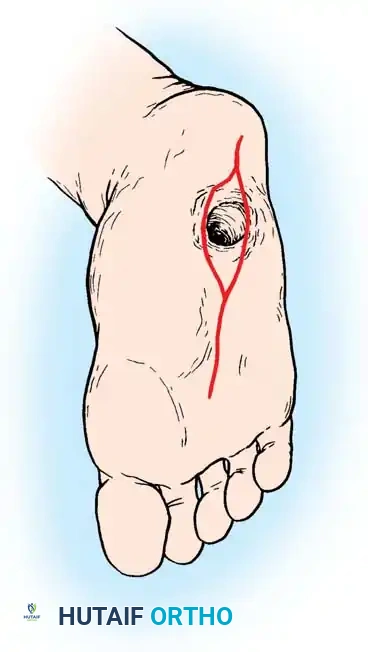 FIXED DEFORMITIES IN THE DIABETIC FOOT Surgical Diagram