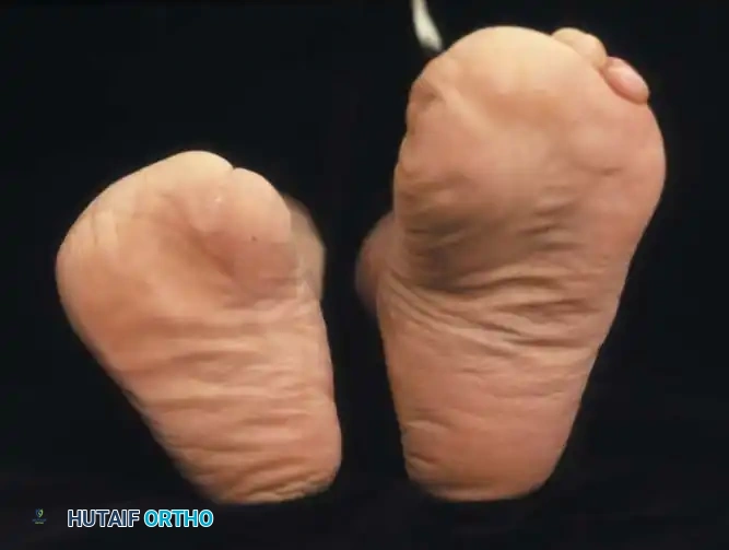 صورة تظهر بتر عبر المشط في القدم اليمنى وبتر المفاصل في القدم اليسرى