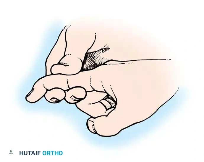Fig. 63-3 If distal interphalangeal joint can be actively fl exed while proximal interphalangeal joint is stabilized, profundus tendon has not been severed.