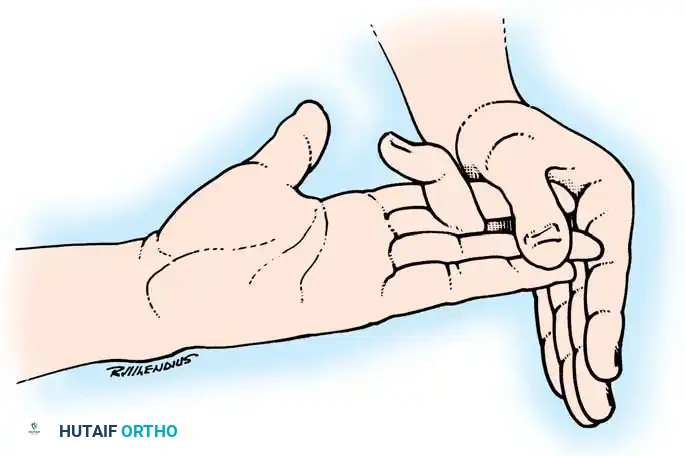 Fig. 63-4 If proximal interphalangeal joint can be actively fl exed while adjacent fi ngers are held completely extended, sublimis tendon has not been severed (see text).