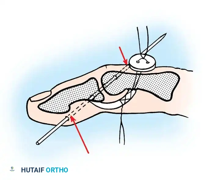 Hutaifortho's Orthopaedic Diagram
