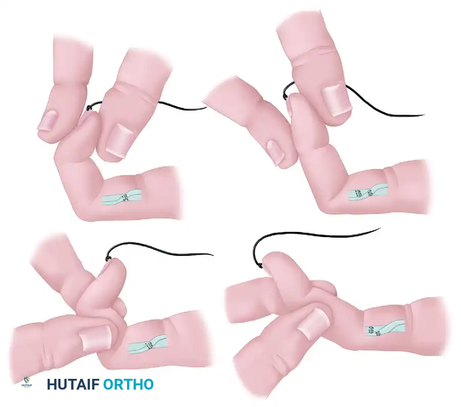 FLEXOR TENDON INJURIES IN CHILDREN Surgical Diagram