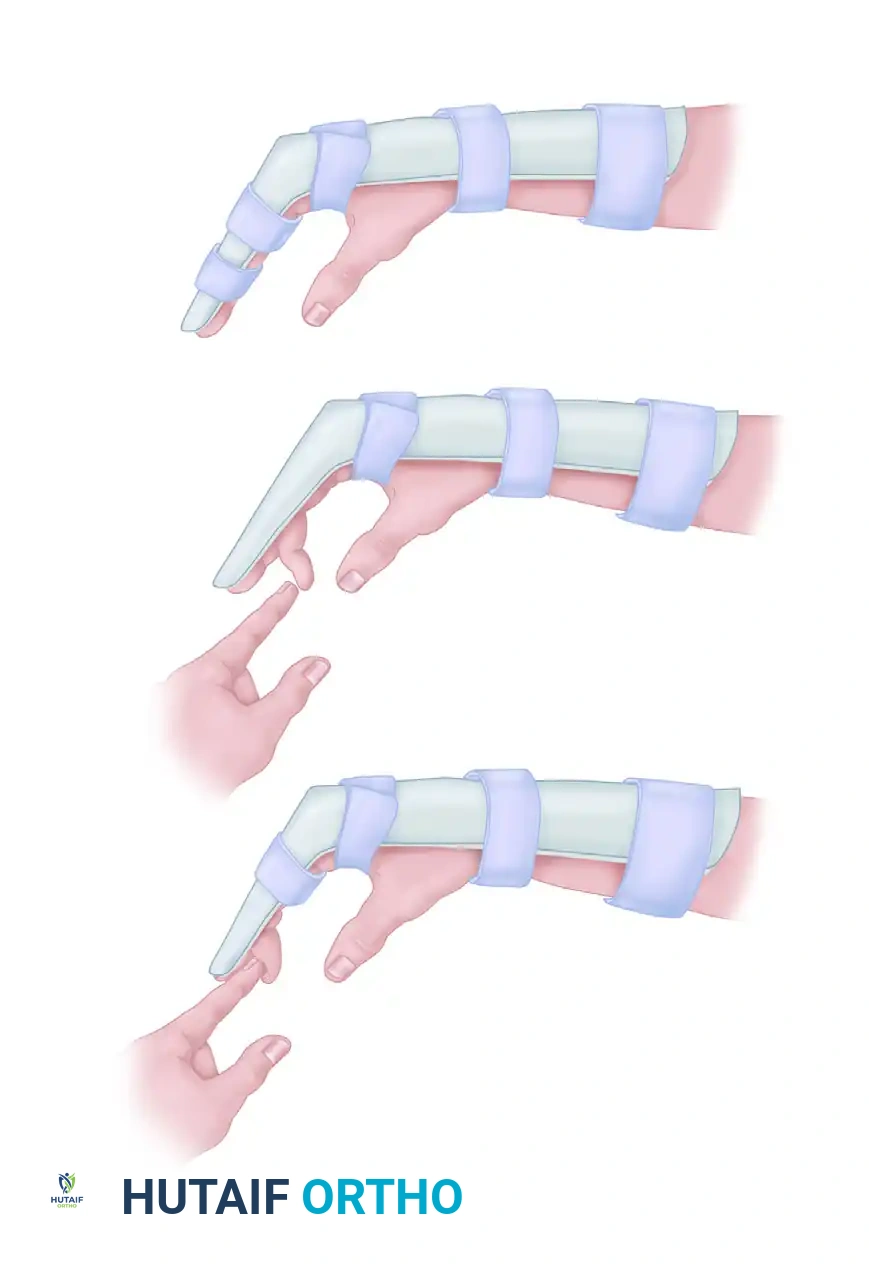 FLEXOR TENDON INJURIES IN CHILDREN Surgical Diagram