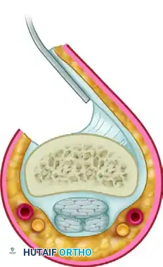 Flexor Tenolysis After Repair and Grafting: Master Surgical Guide