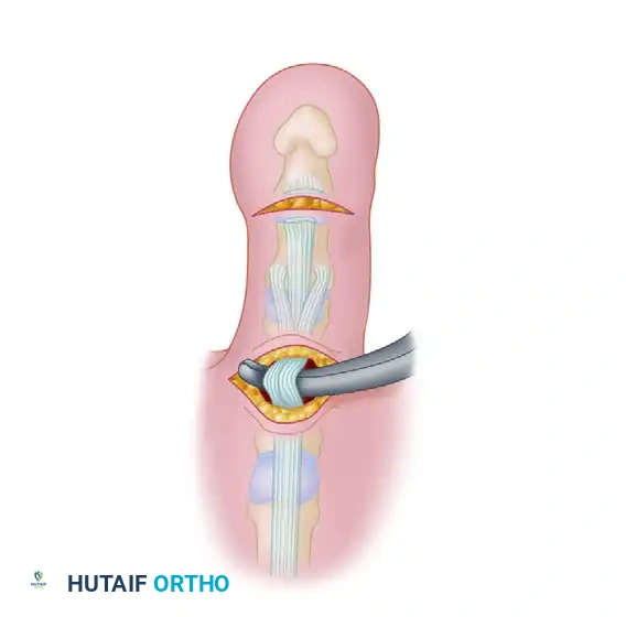 FLEXOR-TO-EXTENSOR TRANSFER Surgical Diagram