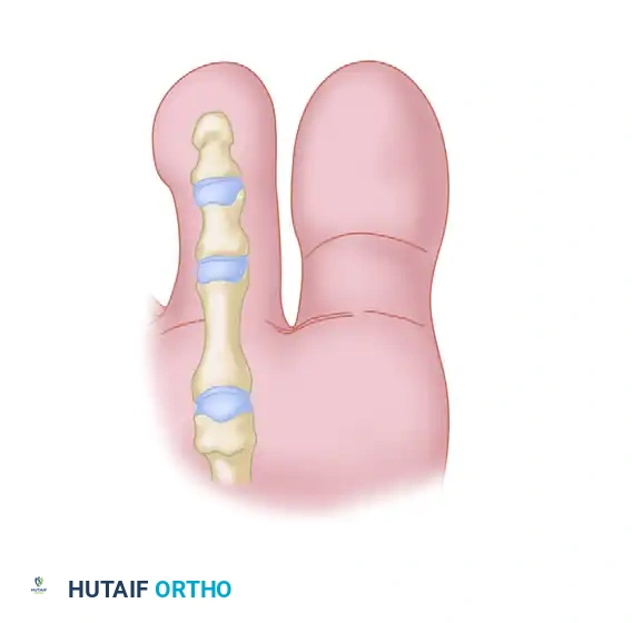 FLEXOR-TO-EXTENSOR TRANSFER Surgical Diagram